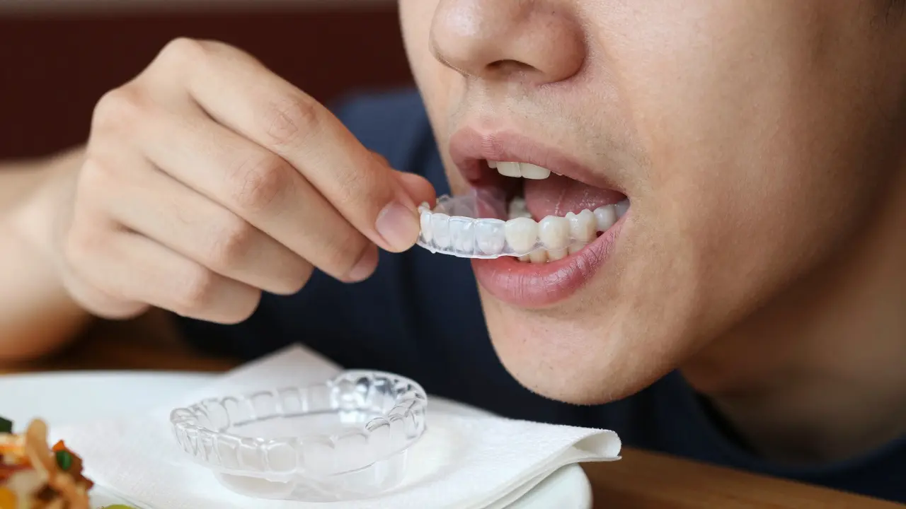 Jak často nosit retencní rovnátka? Praktický průvodce pro po zubních rovnátkách